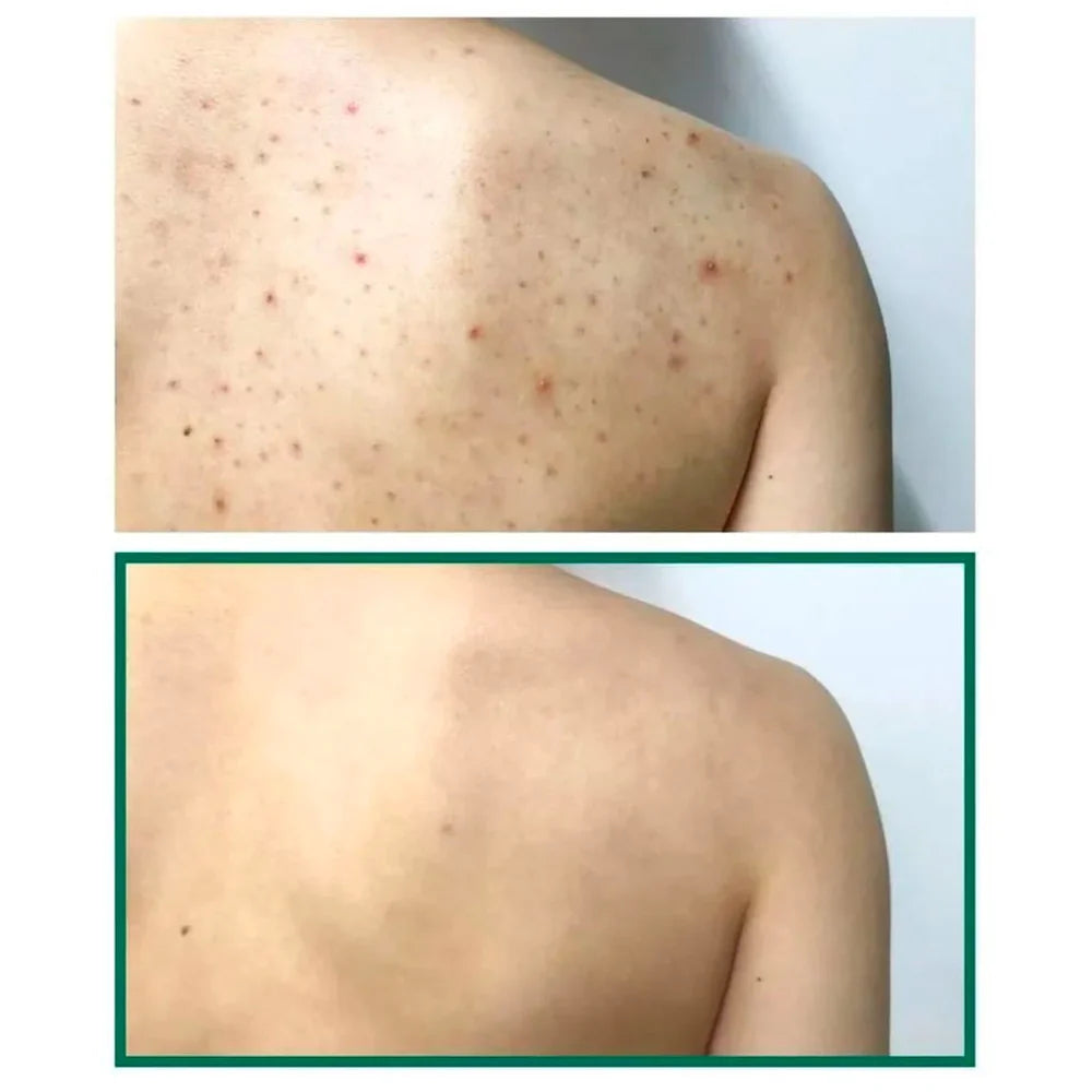 AHA, BHA, PHA 30 Days Miracle Acne Clear Body Cleanser - Jjoseon Beauty