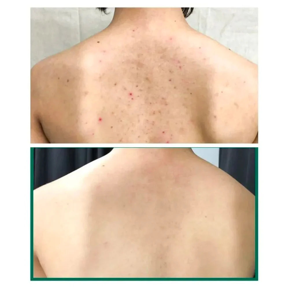 AHA, BHA, PHA 30 Days Miracle Acne Clear Body Cleanser - Jjoseon Beauty