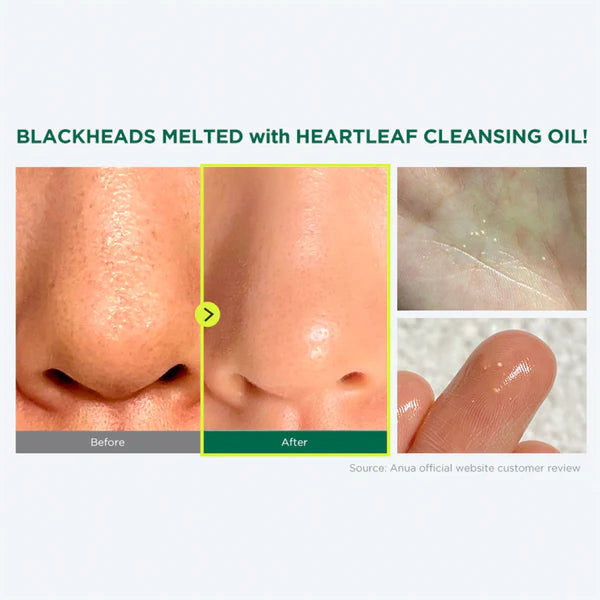 Before and after comparison of blackheads removed with heartleaf cleansing oil.