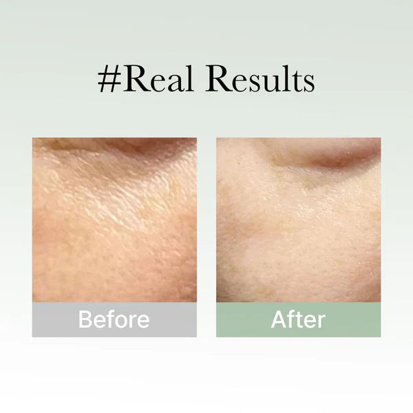 Before and after comparison of skin texture with '#Real Results' text.