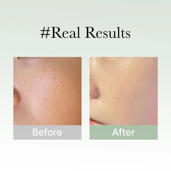 Before and after comparison of skin treatment with '#Real Results' text.