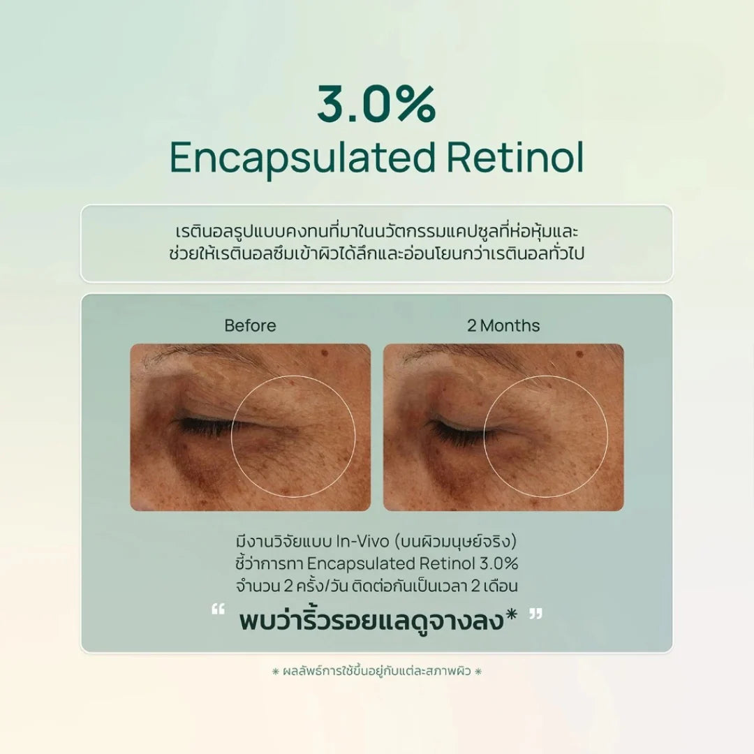 Before and after comparison of眼部皮肤使用3.0% Encapsulated Retinol treatment on a light green background.