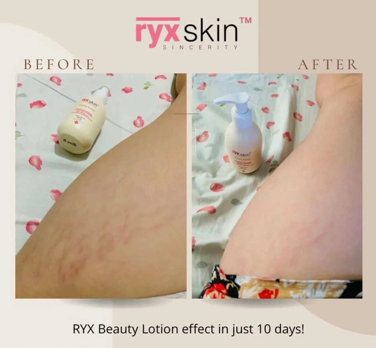 Before and after comparison of RYX Beauty Lotion on a person's leg with visible improvement.